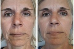 39-Vakuumos-tus-mezoterapia-Diana-Szepsegstudio-Dunaharaszti